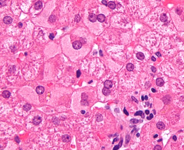 rsz_ground_glass_hepatocytes_high_mag_cropped_2